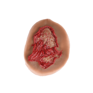 Laerdal Medical-Chemical Burn - Laerdal-MedTech-3